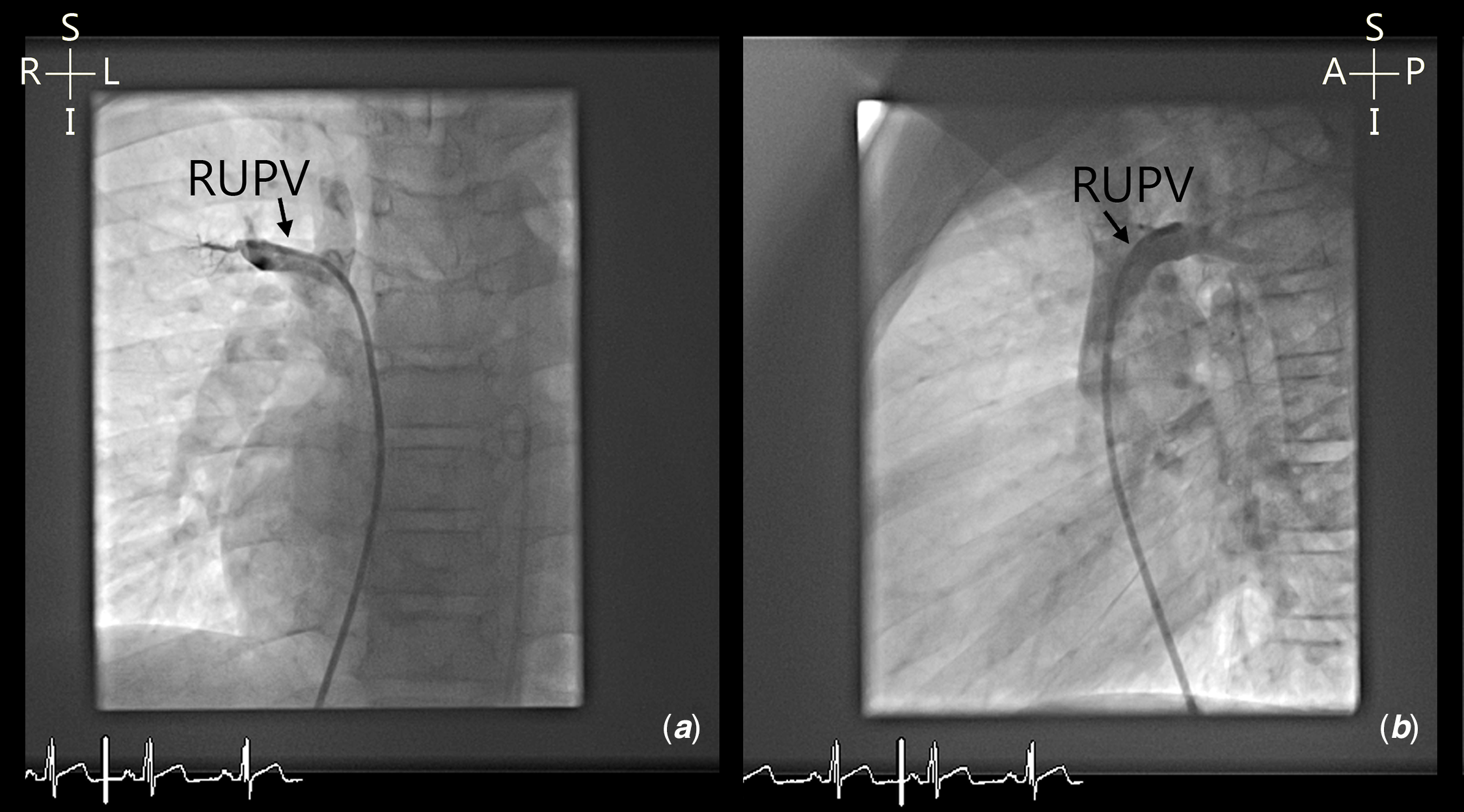 Multimodality imaging in delineation of complex sinus venosus defects and  treatment outcomes over the last decade | Cardiology in the Young |  Cambridge Core