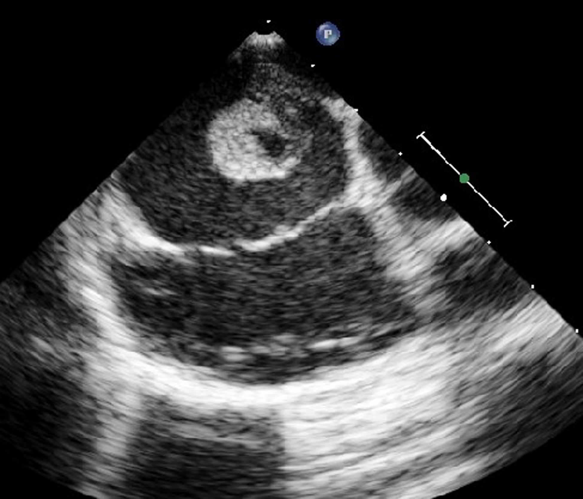 Incidental finding of atrial myxoma following curative treatment for ...