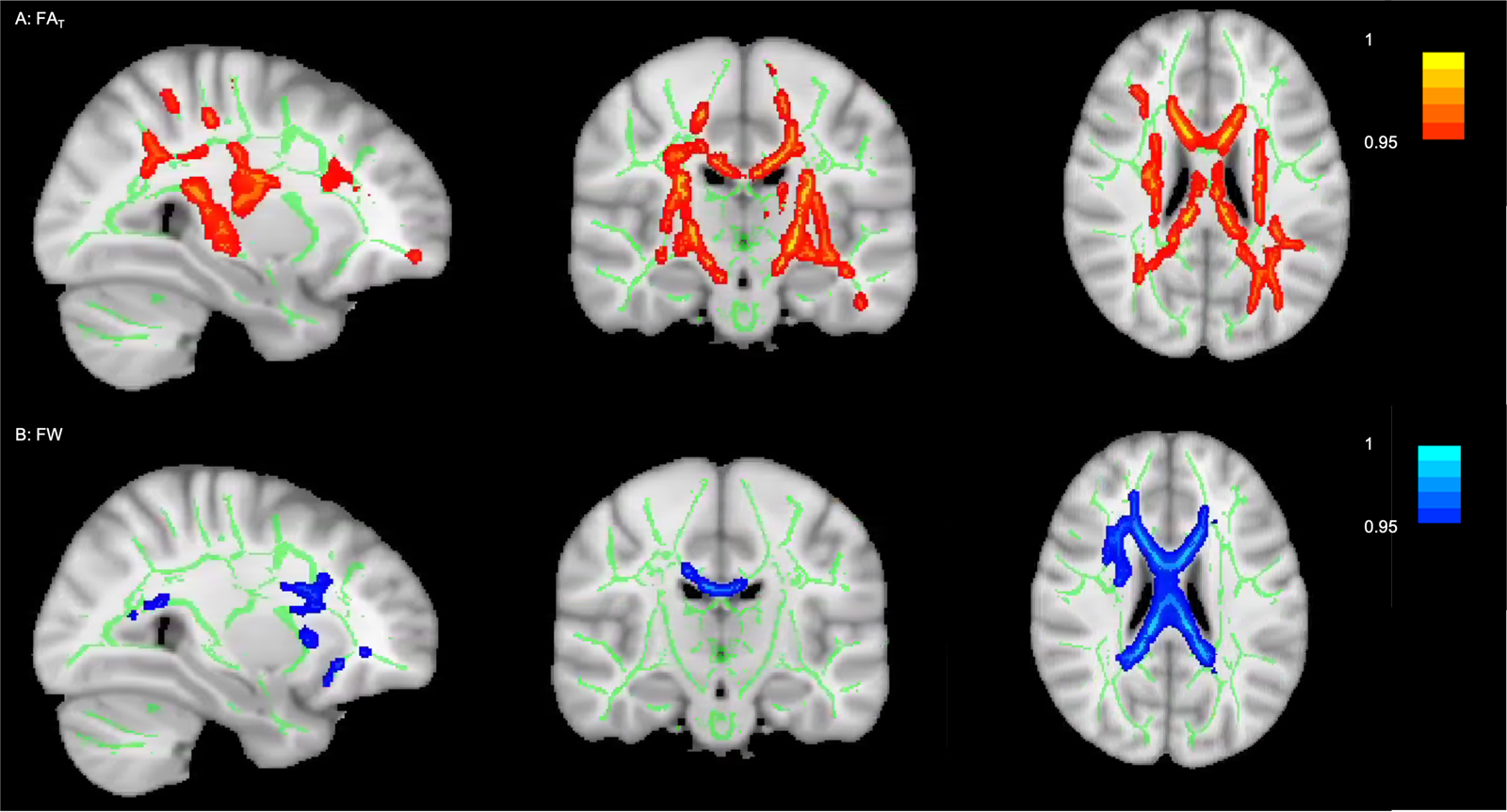 Shared and distinct white matter abnormalities in adolescent