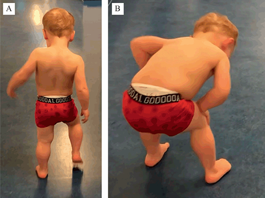 Duchenne Muscular Dystrophy (DMD) (Case 36) - Neuromuscular Disease