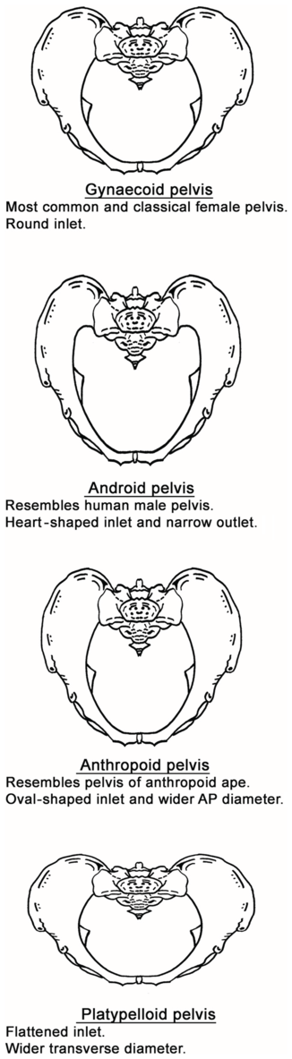 Four diagrams of gynecoid pelvis, android pelvis, anthropoid pelvis and platypelloid pelvis. See long description.