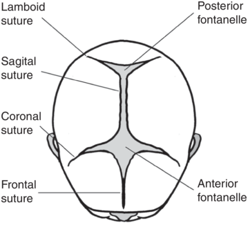 A diagram of a human skull which highlights the sutures and fontanels. The labeled parts are as follows. Lambdoid suture, sagittal suture, coronal suture, frontal suture, posterior fontanels and anterior fontanels.