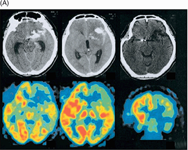 Cognitive and Behavioral Abnormalities of Vascular Cognitive