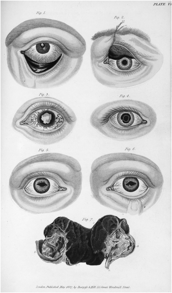 A scientific illustration representing different afflictions of the eye, including inversion of the eyelid, glaucoma, cataract, artificial pupils, and a fungoid tumor. See long description.