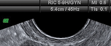An ultrasound scan view with on-screen display of depth, frequency, mechanical index, and thermal index. See long description.
