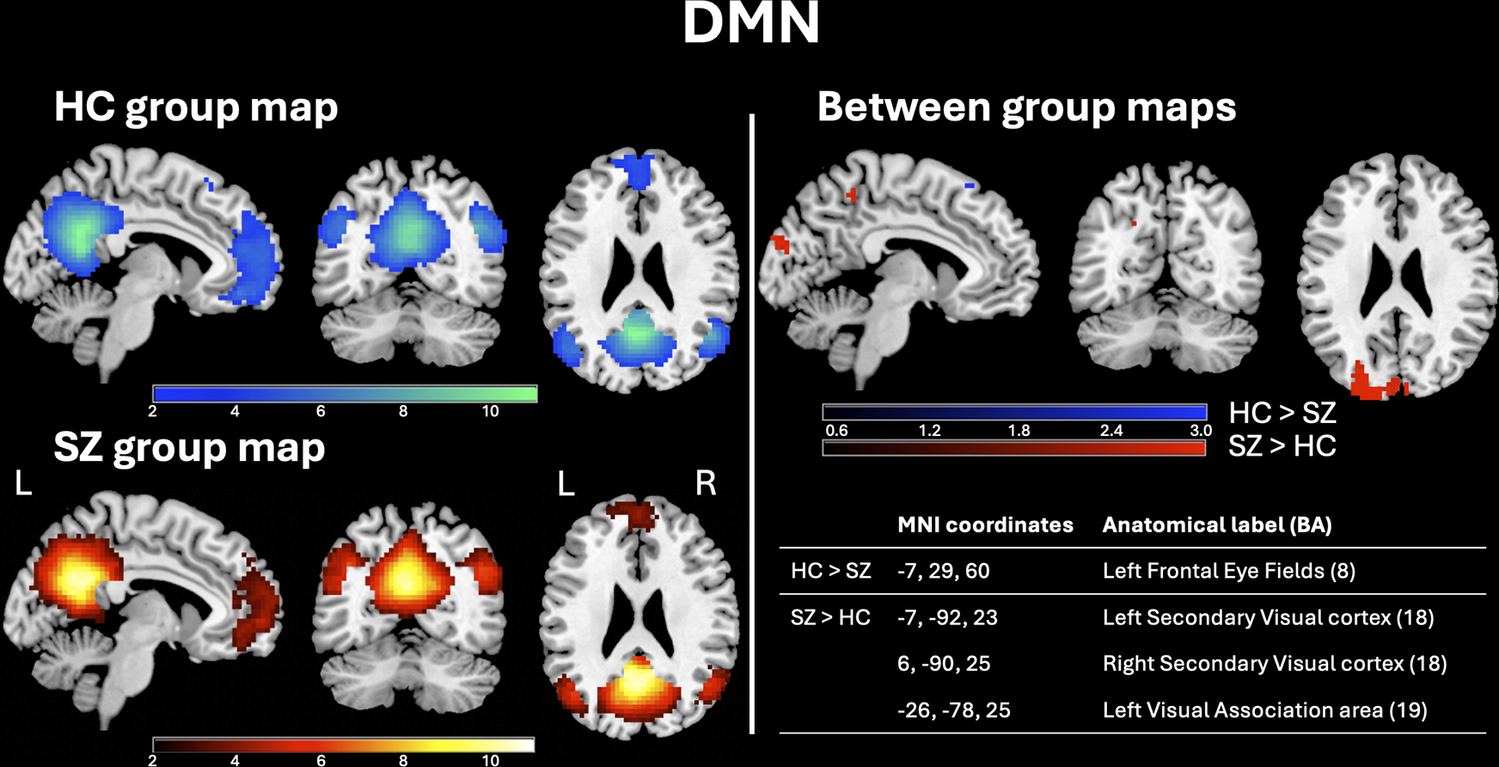 Brain maps of the Default Mode Network (DMN) in healthy controls (blue) and schizophrenia patients (red/yellow), plus between-group differences maps and related coordinates table. See long description.