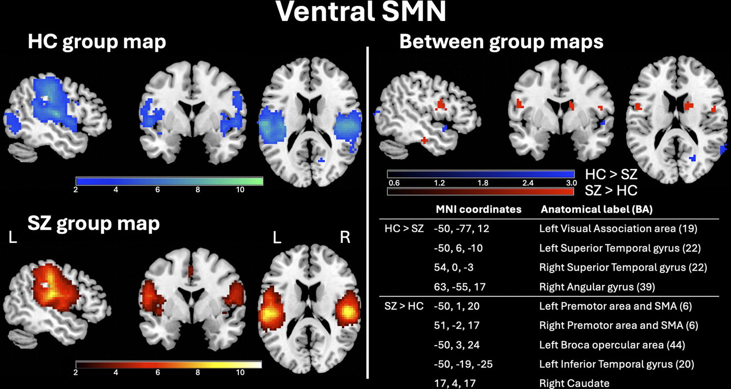 Brain maps of the Ventral Somatomotor network (SMN) in healthy controls (blue) and schizophrenia patients (red/yellow), plus between-group differences maps and related coordinates table. See long description.