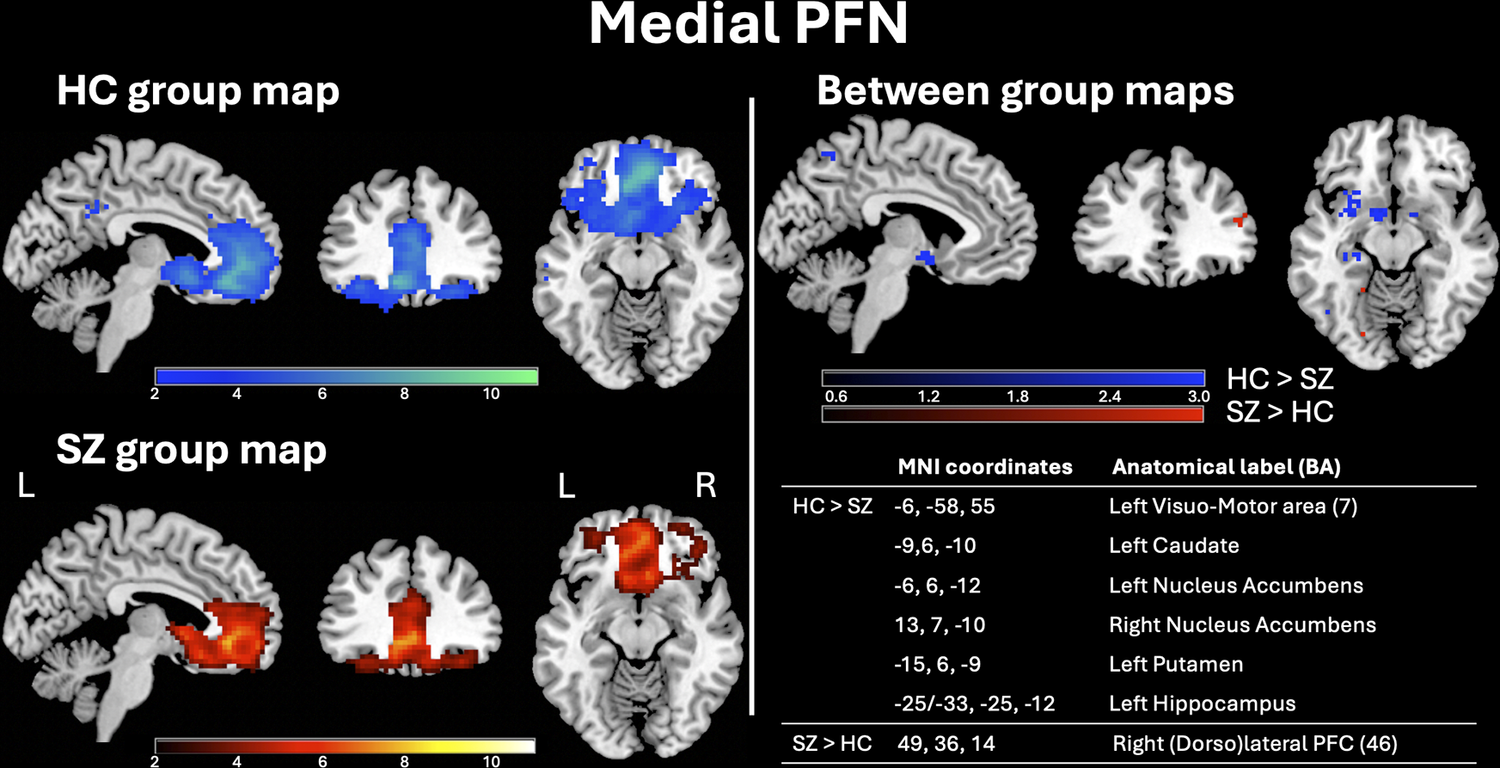 Brain maps of the Medial Prefrontal network (PFN) in healthy controls (blue) and schizophrenia patients (red/yellow), plus between-group differences maps and related coordinates table. See long description.