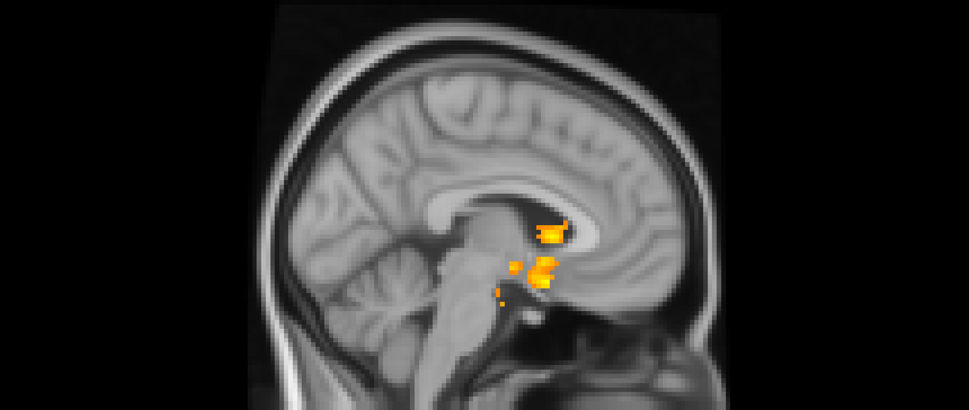 A cross-sectional image of a brain highlighting specific regions with yellow markers.