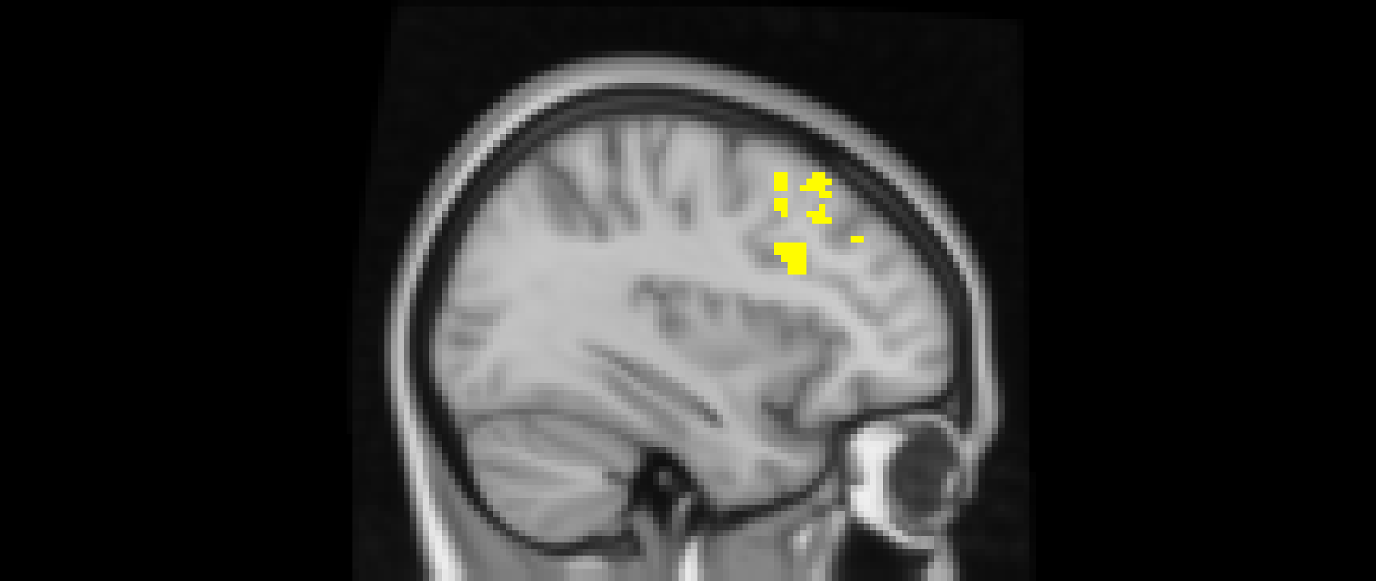 An MRI scan of the brain highlighting specific regions.