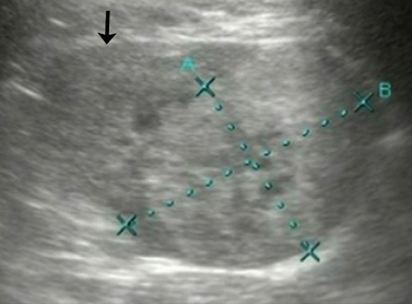 Genitourinary ultrasound (Chapter 8) - Atlas of Emergency