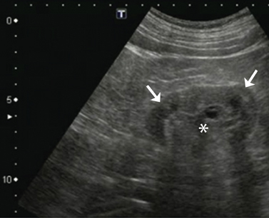 Genitourinary ultrasound (Chapter 8) - Atlas of Emergency Ultrasound