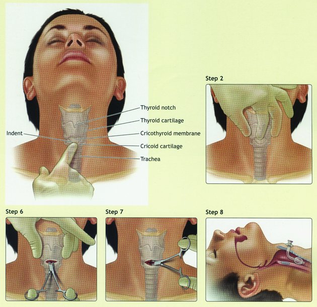 Surgical Cricothyrotomy by the Paramedic Intern 
