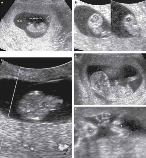 5w5d ultrasound - October 2024 Babies | Forums | What to Expect