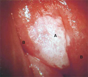 Vaginal mass with necrotic appearance obstructing the vaginal