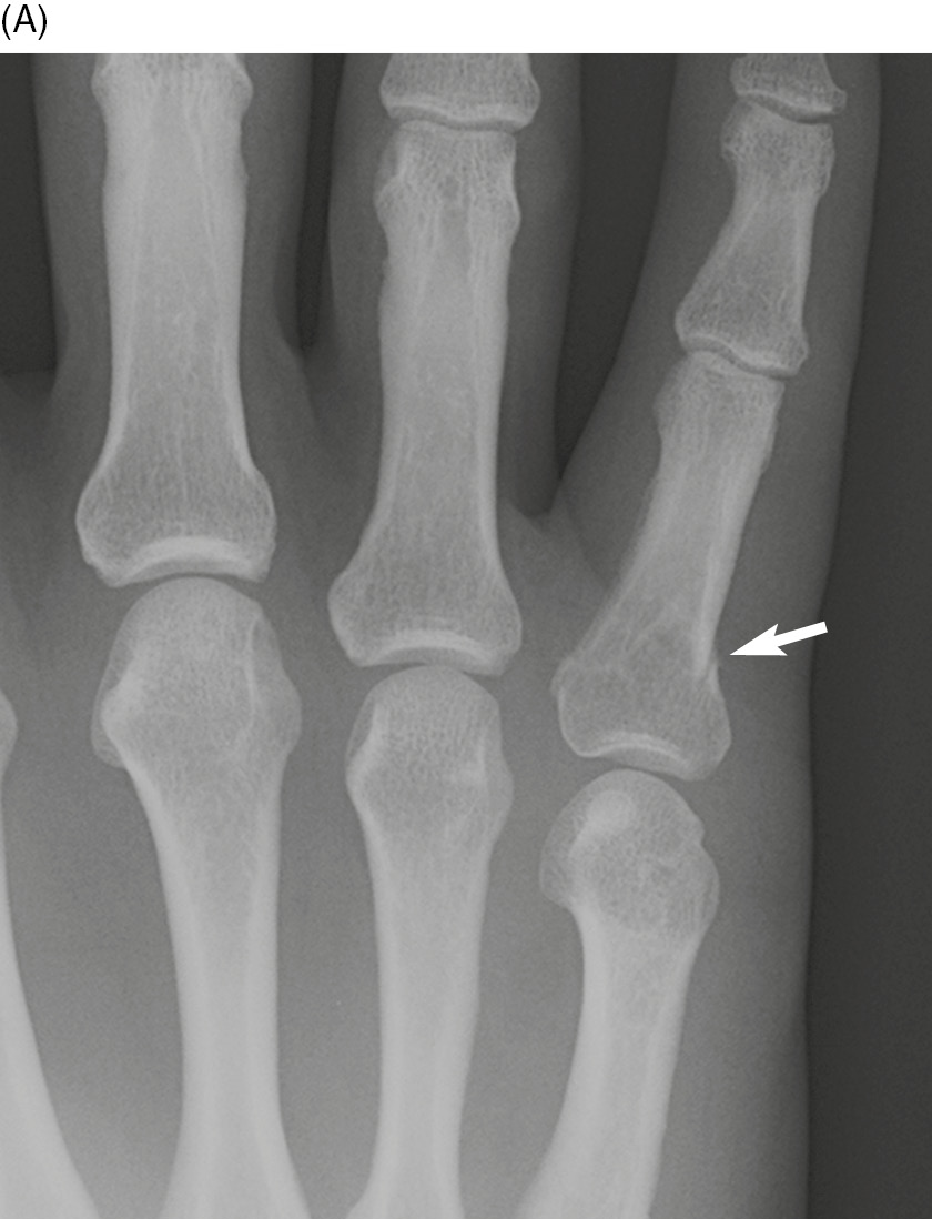 spiral fracture pinky finger