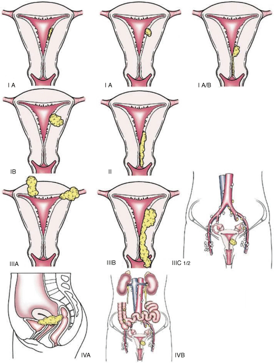 Ovarian cancer leg pain. Ovarian cancer leg pain