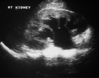 Renal and bladder ultrasound (Chapter 6) - Manual of Emergency and