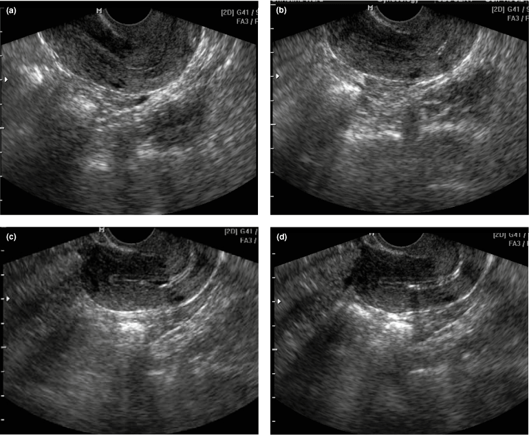Sonographic findings in acute urinary retention secondary to retroverted  gravid uterus: pathophysiology and preventive measures - Yang - 2004 -  Ultrasound in Obstetrics & Gynecology - Wiley Online Library