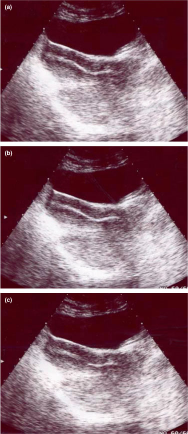 Sonographic findings in acute urinary retention secondary to retroverted  gravid uterus: pathophysiology and preventive measures - Yang - 2004 -  Ultrasound in Obstetrics & Gynecology - Wiley Online Library