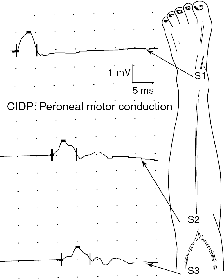 Generalizedneuropathies or polyneuropathies Section C Case