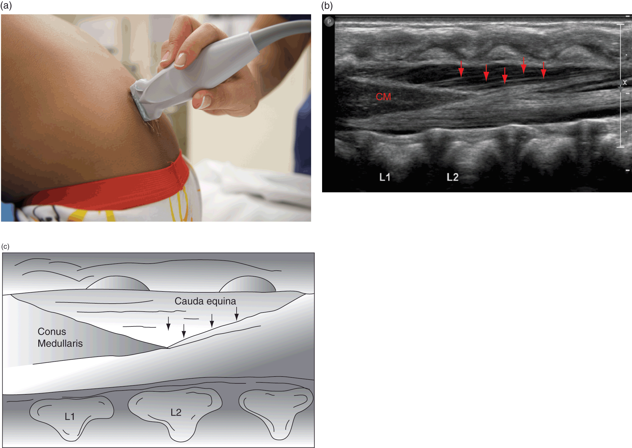 conus medullaris ultrasound