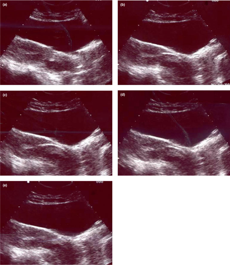 retroverted uterus transabdominal ultrasound