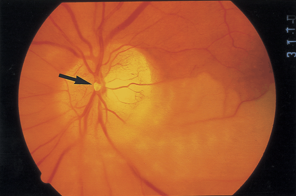 Infectious And Inflammatory Conditions Part I Uncommon Causes Of Stroke