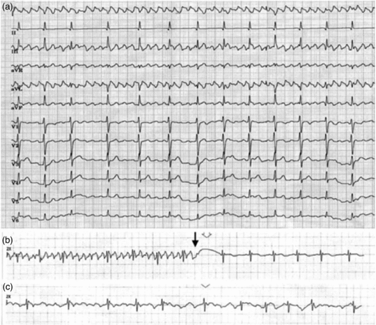 Electrocardiography Chapter 5 Monitoring In Anesthesia And Perioperative Care