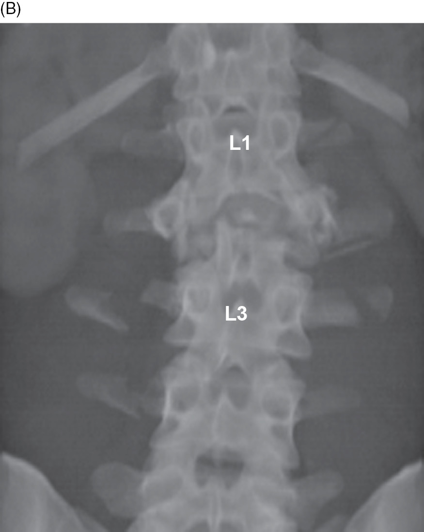 Transverse Process Fracture X Ray