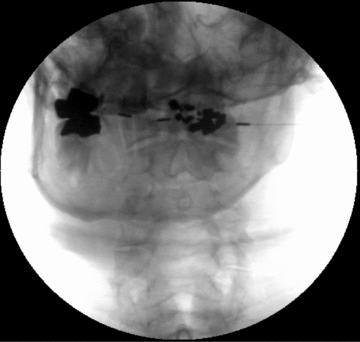 Pain Management Part 27 Essential Clinical Anesthesia