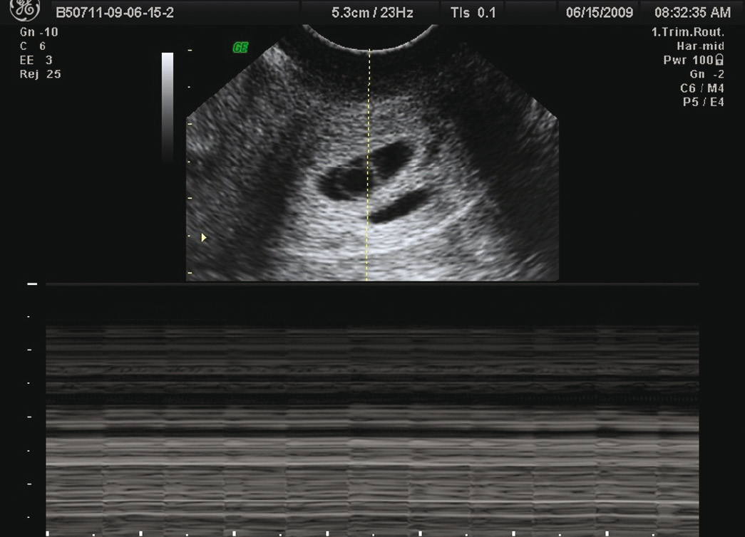 Ultrasound Diagnosis Ofcervical Pregnancy Chapter 16 Ultrasonography In Gynecology