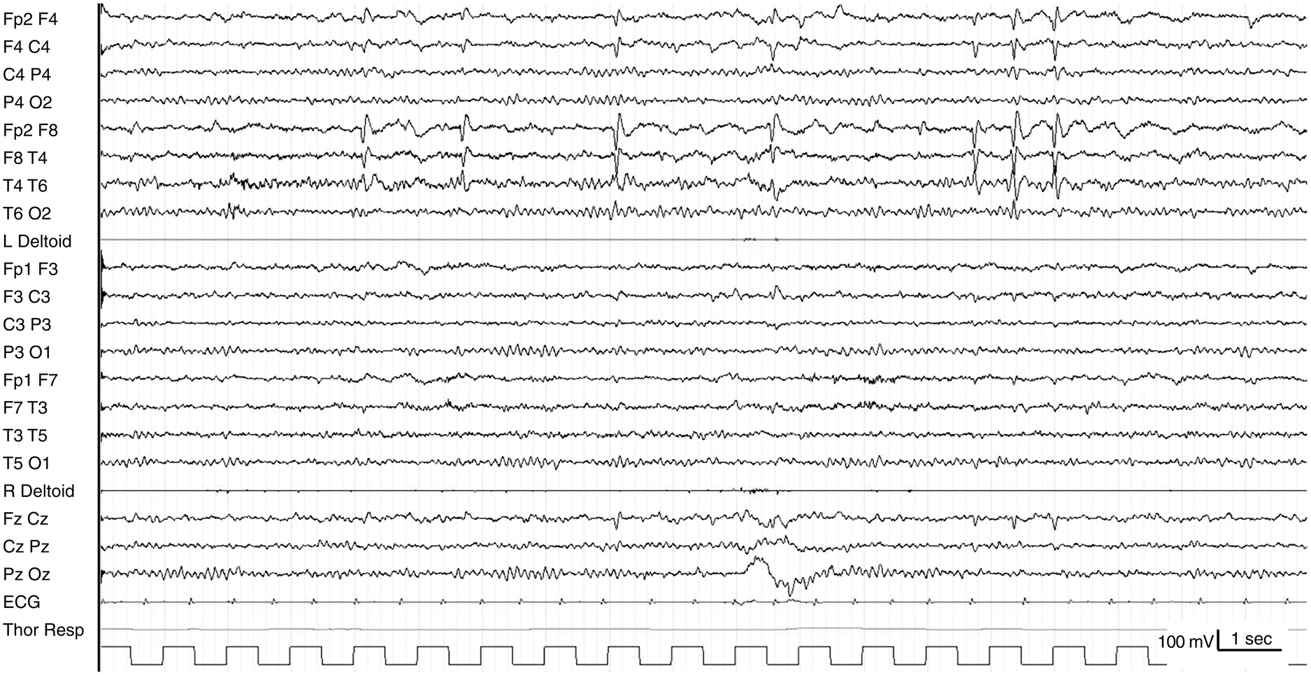 Benign Rolandic Epilepsy Icd 9