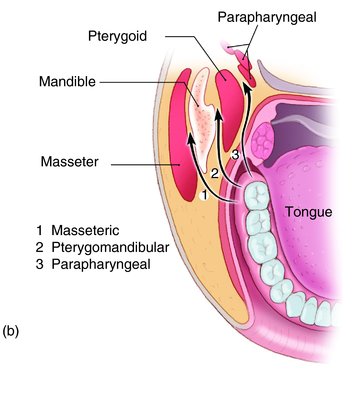 pterygomandibular space abscess