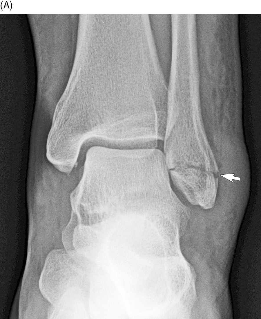 lateral malleolus of fibula