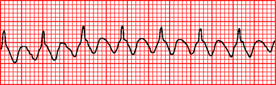 Cardiac Dysrhythmias Chapter 4 An Introduction To Clinical Emergency Medicine