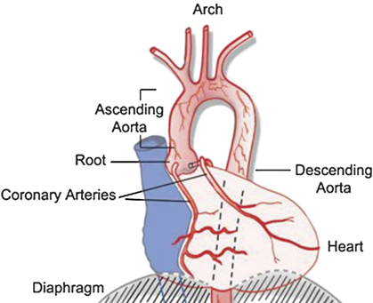 The Thoracic Aorta Chapter 12 Core Topics In Transesophageal