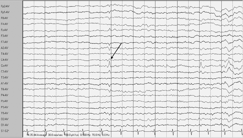 posts eeg