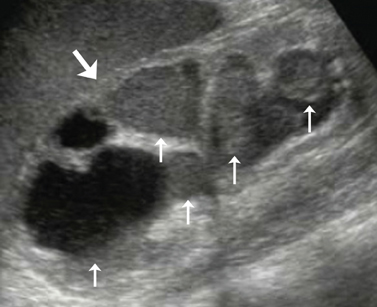 Genitourinary ultrasound (Chapter 8) - Atlas of Emergency Ultrasound