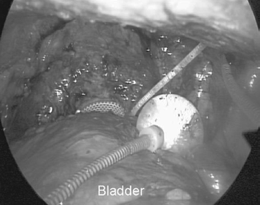 prostatitis éles mennyi ideig tart