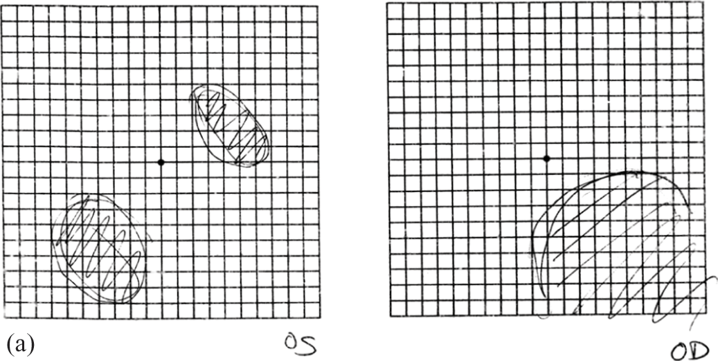 Amsler Grid Pdf - Fill and Sign Printable Template Online