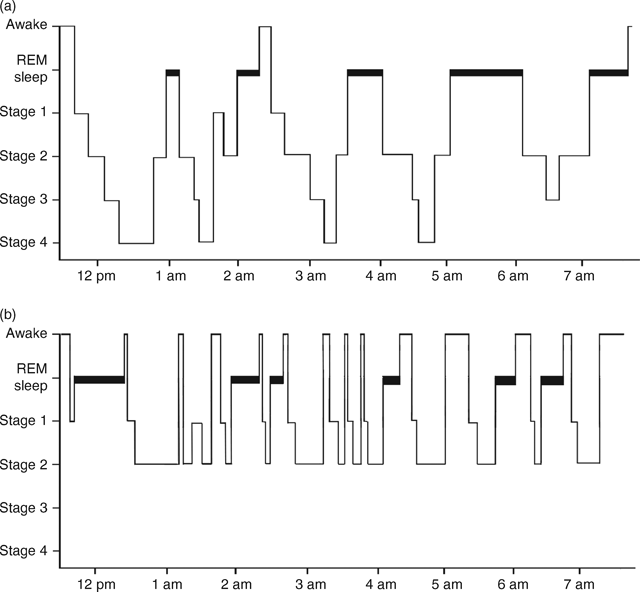 Neurochemistry And Neurophysiology Of Sleep Abnormalities Associated With Depression Chapter 4 Sleep And Mental Illness