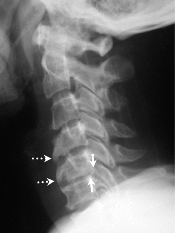 abnormal cervical spine xray