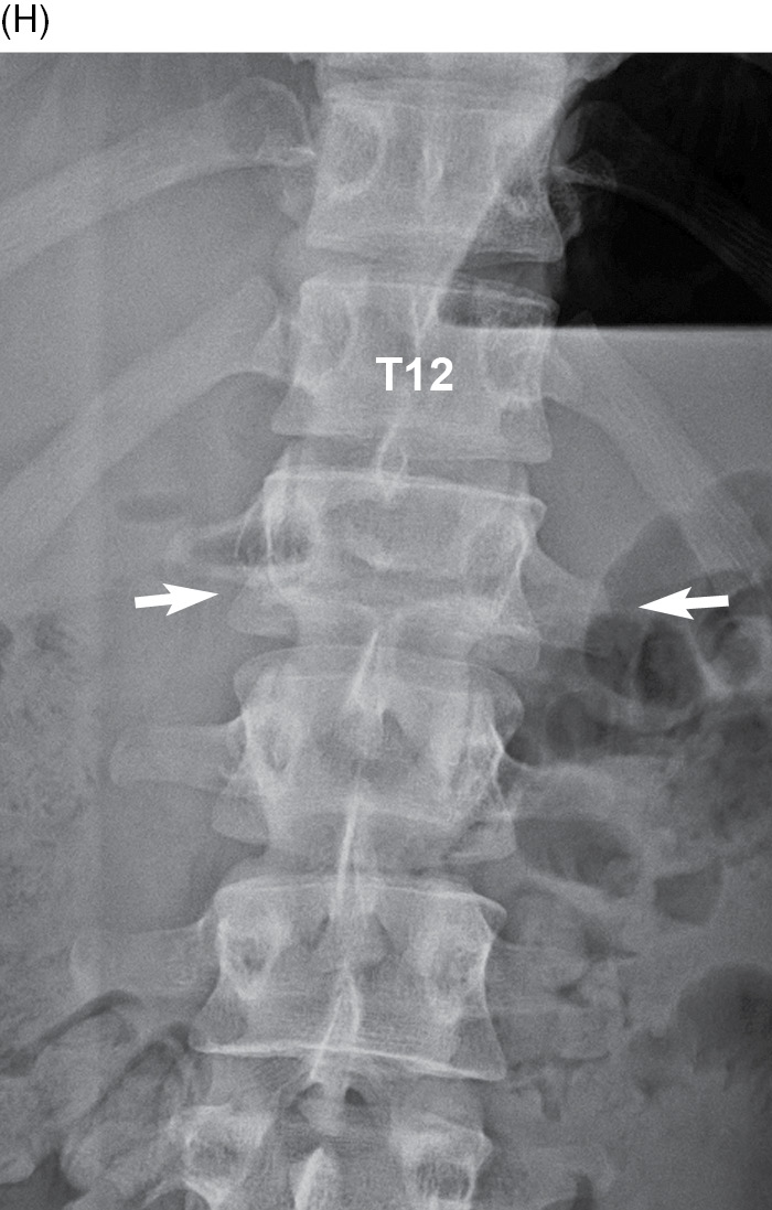 Fractures and dislocations of the thoracolumbosacral spine (Chapter 8) -  Broken Bones