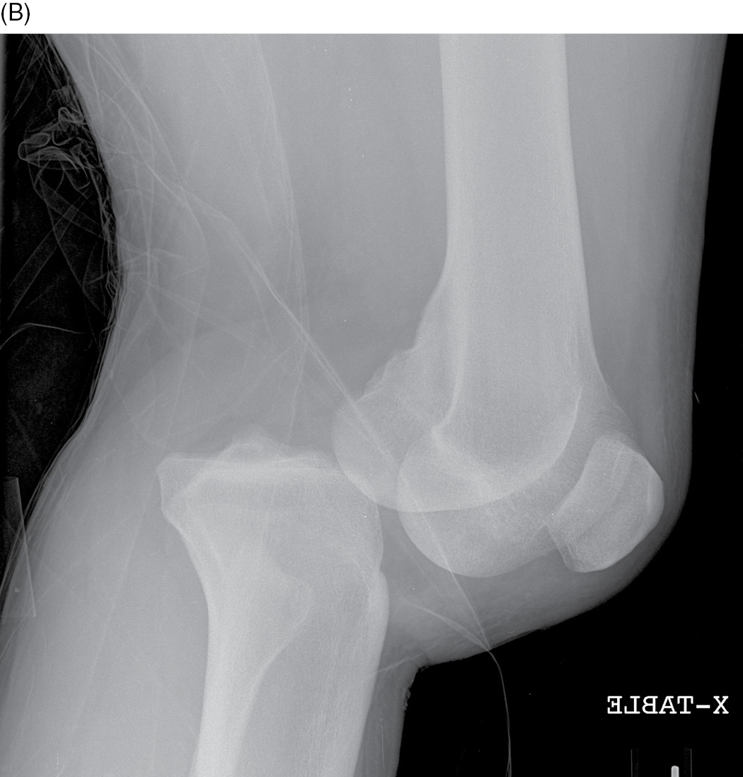 knee dislocation x ray