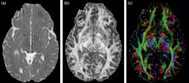 Diffusion Tensor Imaging In Developmental Clinical Neuroscience Chapter 19 Neuroimaging In Developmental Clinical Neuroscience