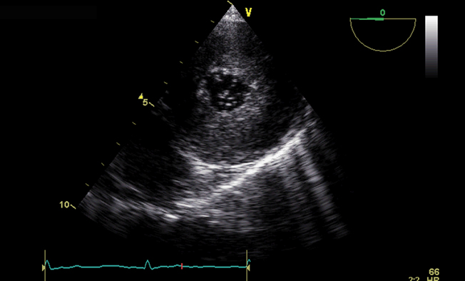 Case 43: Significant Spontaneous Echo Contrast In Left Ventricle (  DCM/Severe LV Dysfunction / LVEF : 15% in M- Mode / LVEF : 10% In Simpson's  Method., By Interesting cases in Echocardiography