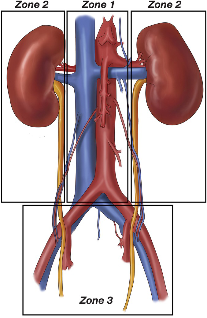 AbdominalPelvic Vascular Trauma - The Operative Review Of Surgery