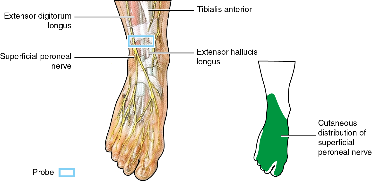 Superficial Peroneal Nerve Block