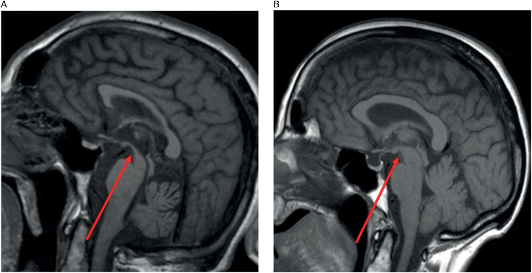 Clinical Applications Chapter 17 Magnetic Resonance Imaging In Movement Disorders